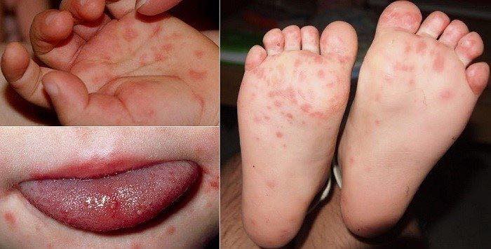 Chủ động phòng chống bệnh tay chân miệng- Ảnh 1.