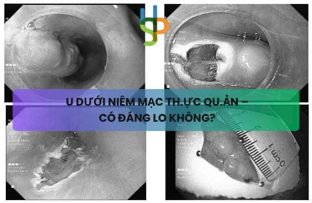 U dưới niêm mạc thực quản- có đáng lo không?- Ảnh 1.
