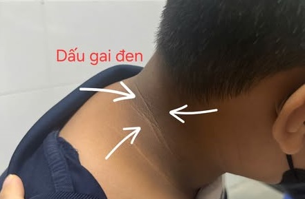 Dấu gai đen – cảnh báo âm thầm về sức khỏe trẻ thừa cân béo phì- Ảnh 1.