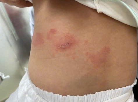 Zona thần kinh ở trẻ nhũ nhi – trường hợp hiếm gặp nhưng không thể chủ quan- Ảnh 1.