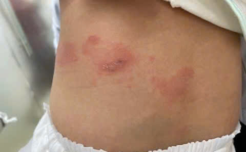 Cảnh giác với bệnh Zona ở trẻ nhũ nhi- Ảnh 1.