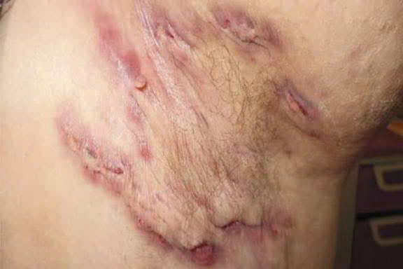 Bệnh viện Da Liễu Hà Nội khuyến cáo: Viêm tuyến mồ hôi mủ không chỉ là mụn nhọt thông thường- Ảnh 1.