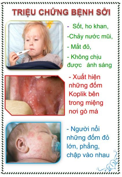 BÀI TUYÊN TRUYỀN PHÒNG BỆNH SỞI- Ảnh 2.