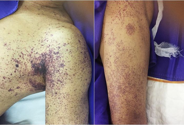 NHẬN BIẾT VÀ CÁCH PHÒNG BỆNH LIÊN CẦU LỢN Ở NGUỜI - Ảnh 3.