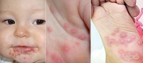 CÁCH PHÒNG, CHỐNG BỆNH TAY CHÂN MIỆNG- Ảnh 1.
