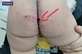 CÁCH PHÒNG, CHỐNG BỆNH TAY CHÂN MIỆNG- Ảnh 4.