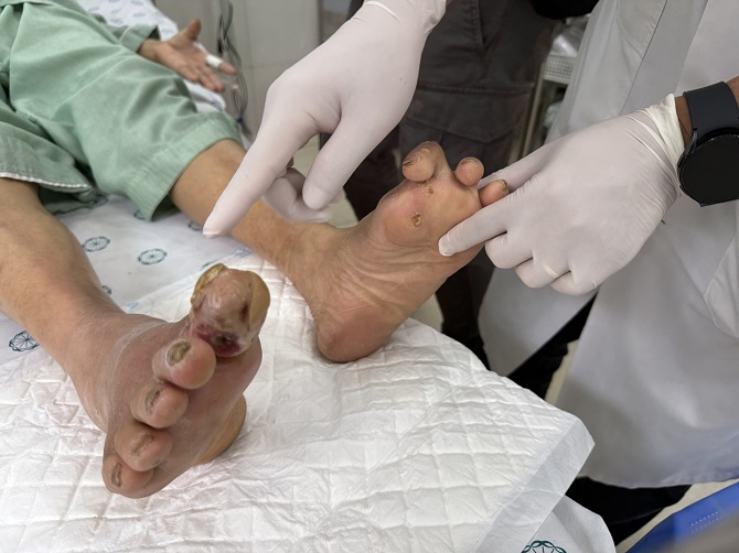 Phát hiện sớm các tổn thương bàn chân ở người bệnh đái tháo đường có vai trò hết sức quan trọng- Ảnh 2.