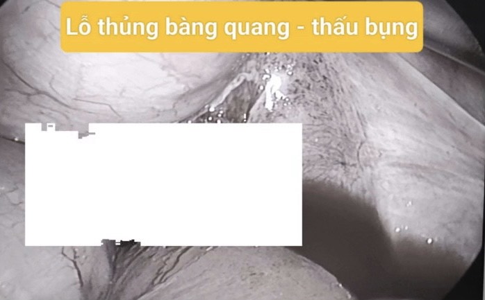 Phẫu thuật cứu sống bệnh nhân bị thanh sắt xuyên thủng trực tràng và bàng quang- Ảnh 1.