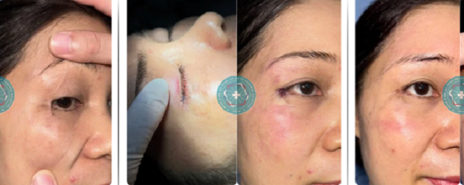 Những điều cần biết về phẫu thuật sửa sẹo để mang lại chất lượng cuộc sống- Ảnh 1.