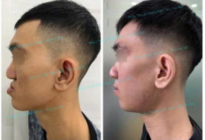 Đơn nguyên phẫu thuật Tạo hình & Hàm mặt tại Bệnh viện Nhi Hà Nội tạo nhiều dấu ấn trong các ca phẫu thuật tạo hình- Ảnh 1.