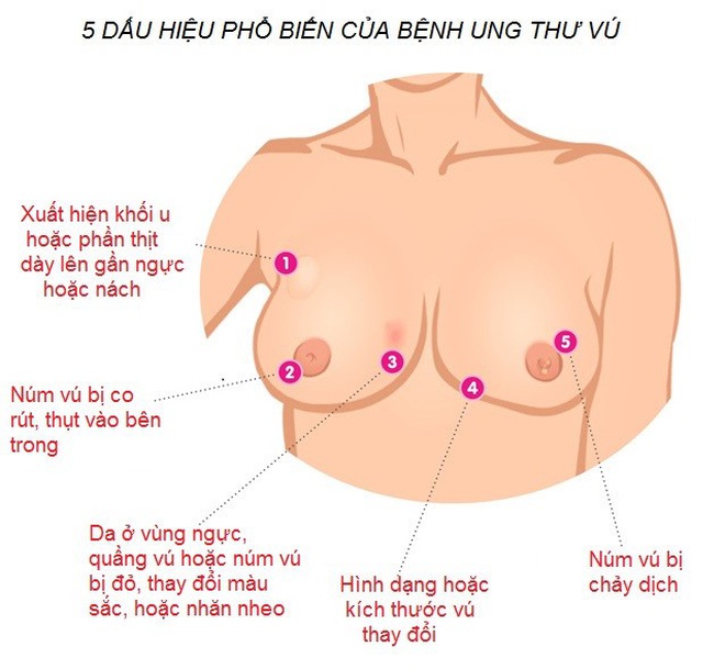 Tầm soát và chẩn đoán sớm ung thư vú giúp nâng cao hiệu quả điều trị- Ảnh 1.