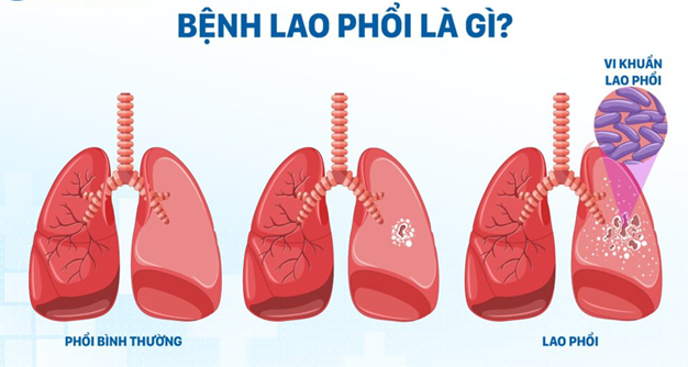 Những điều cần biết về bệnh Lao và cách phòng tránh- Ảnh 1.