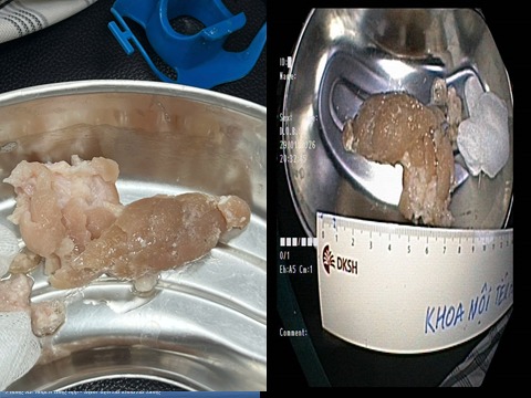 Nuốt miếng thịt gây hóc dị vật, bác sĩ khuyến cáo người dân cẩn trọng- Ảnh 1.