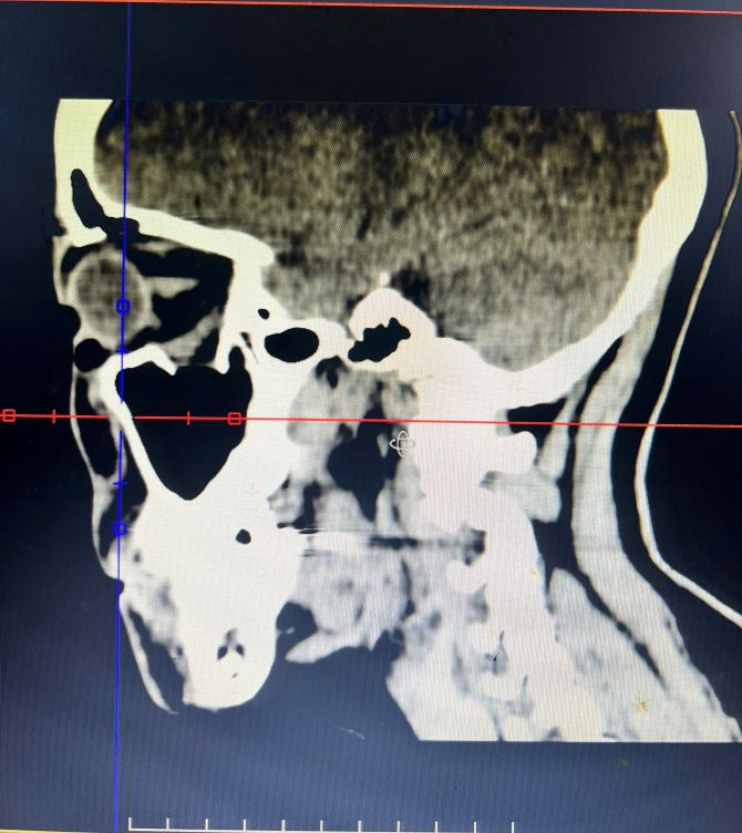 Cấp cứu kịp thời ca chấn thương hàm mặt phức tạp, phục hồi thị lực cho người bệnh- Ảnh 1.