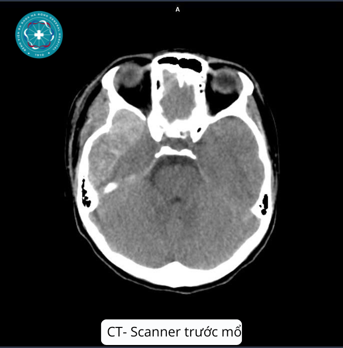 Bệnh viện đa khoa Hà Đông - cuộc đua giành lại sự sống cho bệnh nhân 14 tuổi- Ảnh 1.