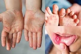 Xã Suối Hai tăng cường phòng, chống bệnh tay chân miệng và các bệnh truyền nhiễm- Ảnh 1.