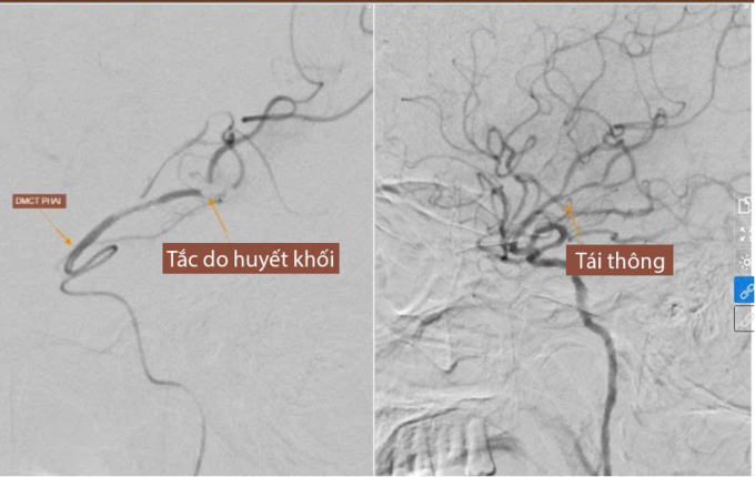 Ba can thiệp trong 'giờ vàng' cứu người đột quỵ- Ảnh 1.