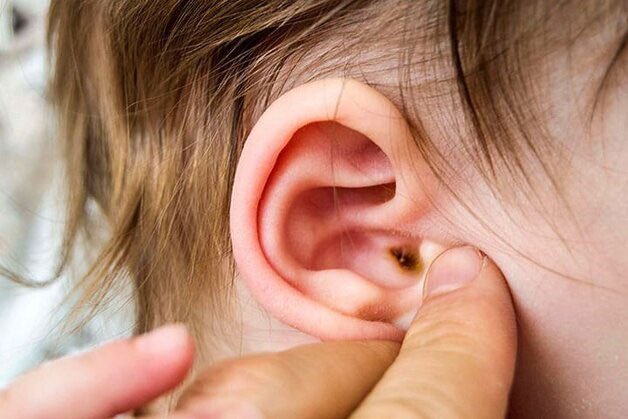 Cần phát hiện sớm, điều trị kịp thời viêm tai giữa để bảo vệ thính lực và sự phát triển của trẻ- Ảnh 1.