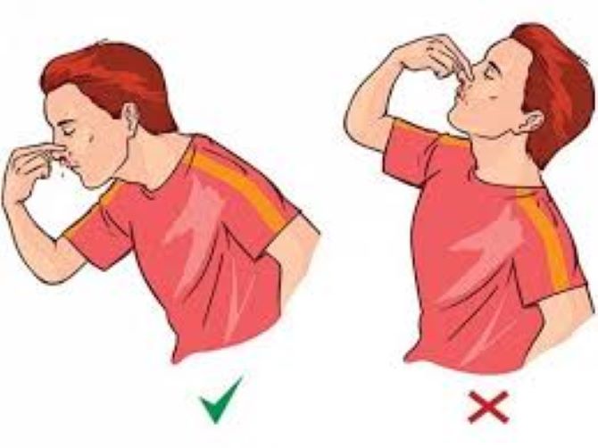 Cần xử trí chảy máu cam đúng cách để tránh biến chứng- Ảnh 1.