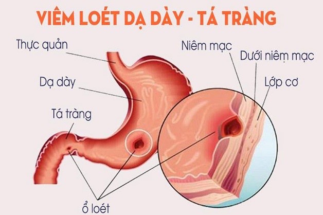 Đừng xem nhẹ viêm loét dạ dày - tá tràng ở trẻ vị thành niên- Ảnh 1.