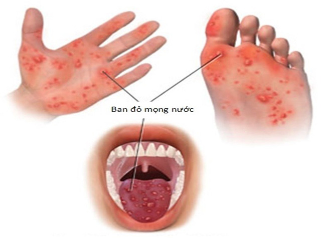 Những điều cần biết về bệnh tay chân miệng: Trẻ mắc nhiều lần có nguy hiểm không?- Ảnh 1.