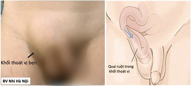Thoát vị bẹn ở trẻ: 3 dấu hiệu cần đưa trẻ đi khám sớm- Ảnh 1.