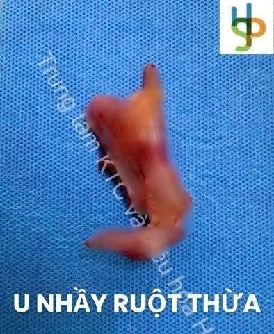 U nhầy ruột thừa: Mối nguy âm thầm không nên xem nhẹ- Ảnh 1.