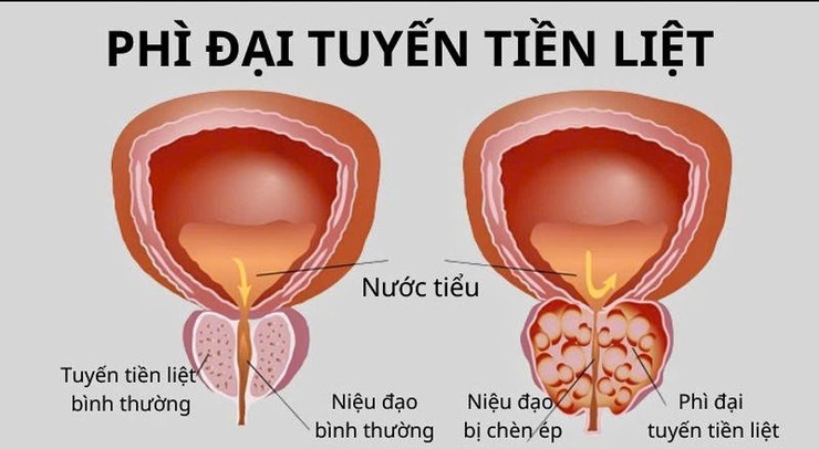 Bệnh viện đa khoa Mỹ Đức phẫu thuật nội soi tuyến tiền liệt bằng dao điện lưỡng cực- Ảnh 1.
