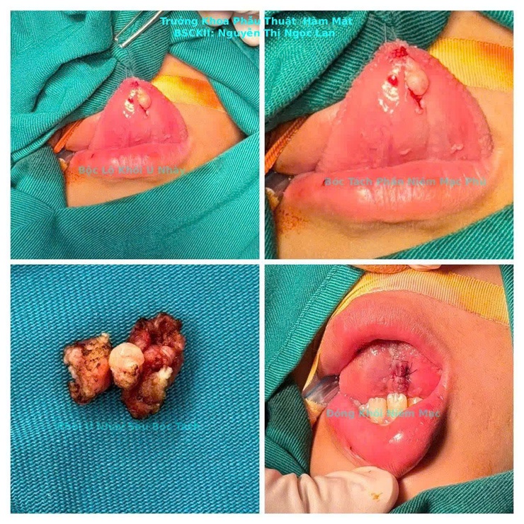 Bệnh viện Nhi Hà Nội phẫu thuật thành công cho bệnh nhi bị u nhầy lưỡi- Ảnh 1.