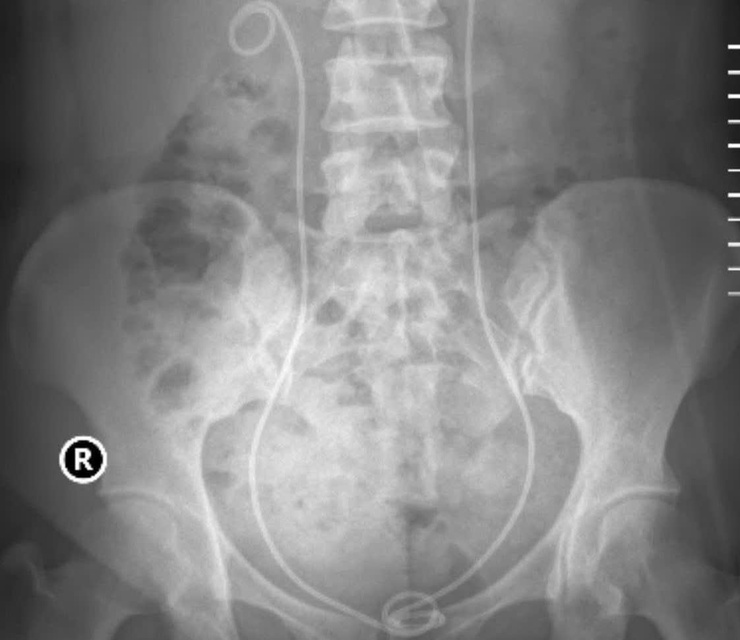 Bệnh viện Thận Hà Nội phối hợp linh hoạt các kỹ thuật tán sỏi hiện đại trong điều trị- Ảnh 1.