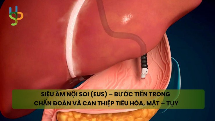 Siêu âm nội soi (EUS) bước tiến trong chẩn đoán và can thiệp các bệnh lý tiêu hóa, mật tụy- Ảnh 1.
