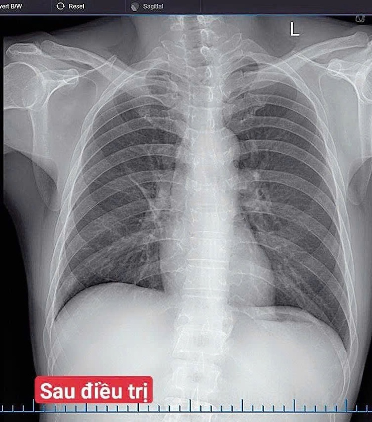 Điều trị thành công ca viêm phổi cộng đồng trên bệnh nhân xơ gan, viêm gan B tại Bệnh viện Đa khoa Vân Đình- Ảnh 2.