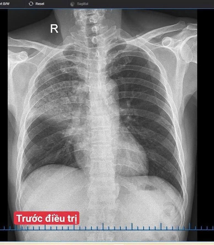 Điều trị thành công ca viêm phổi cộng đồng trên bệnh nhân xơ gan, viêm gan B tại Bệnh viện Đa khoa Vân Đình- Ảnh 1.