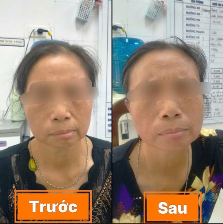 Hiệu quả điều trị liệt dây thần kinh số VII ngoại biên sau 14 ngày tại Bệnh viện đa khoa Vân Đình- Ảnh 2.