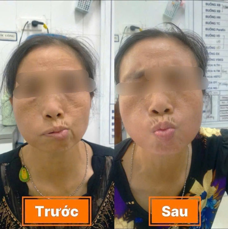Hiệu quả điều trị liệt dây thần kinh số VII ngoại biên sau 14 ngày tại Bệnh viện đa khoa Vân Đình- Ảnh 1.