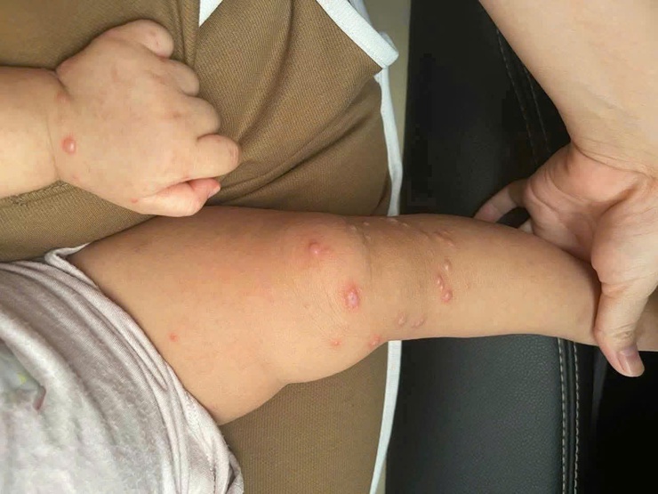 BVĐK Phúc Thọ khuyến cáo phòng chống tay chân miệng chung tay bảo vệ sức khoẻ trẻ nhỏ- Ảnh 2.
