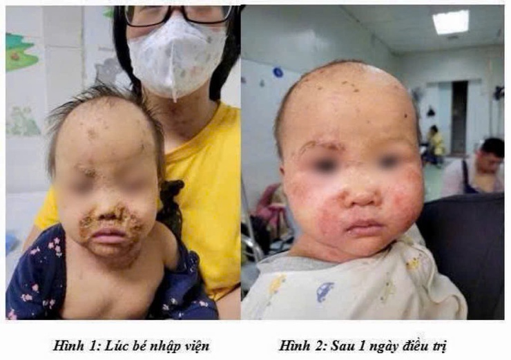 Không tự ý dùng thuốc điều trị viêm kết mạc ở trẻ nhỏ- Ảnh 1.