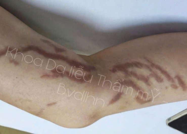 Điều trị tăng sắc tố sau viêm (PIH): Bệnh viện Da liễu Hà Nội triển khai nhiều kỹ thuật chuyên sâu, hiệu quả và an toàn- Ảnh 1.