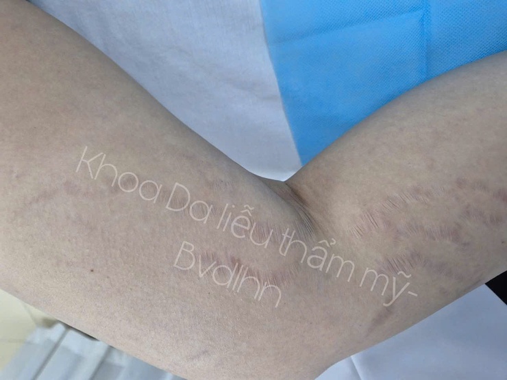 Điều trị tăng sắc tố sau viêm (PIH): Bệnh viện Da liễu Hà Nội triển khai nhiều kỹ thuật chuyên sâu, hiệu quả và an toàn- Ảnh 2.