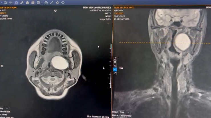 Ứng dụng kỹ thuật mới để bóc tách khối u nằm sâu trong vùng đầu cổ mà không cần rạch mở từ ngoài- Ảnh 1.