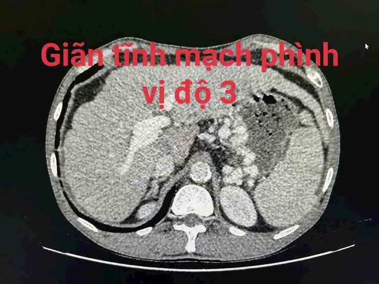 Bệnh viện Thanh Nhàn: Bảo vệ sức khỏe gan là cách tốt nhất để ngăn ngừa nguy cơ xuất huyết tiêu hóa và các biến chứng nguy hiểm khác- Ảnh 1.