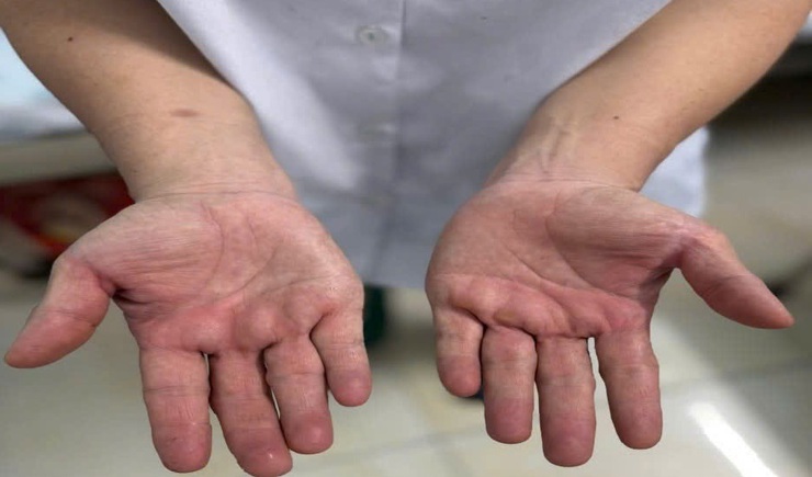 Điều trị hội chứng ống cổ tay bằng phương pháp cổ truyền- Ảnh 1.