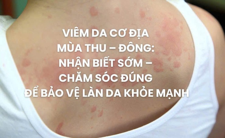 Viêm da cơ địa mùa thu đông: nhận biết sớm và chăm sóc đúng cách để giữ làn da khỏe mạnh - Khuyến cáo từ chuyên gia- Ảnh 1.