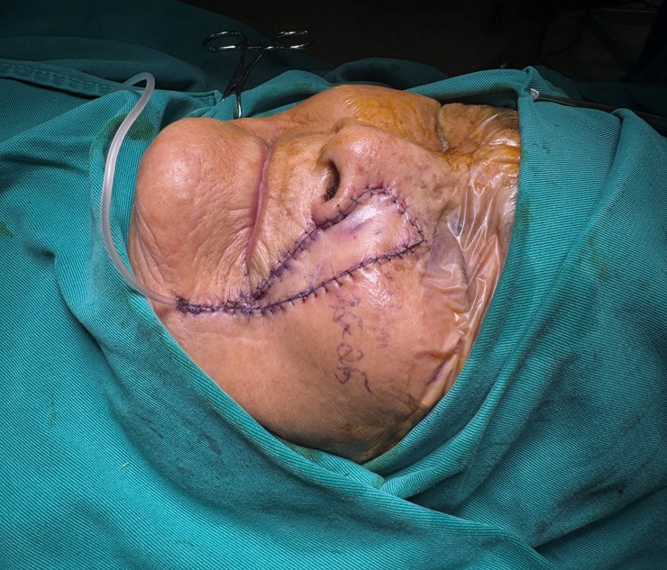 Ứng dụng phẫu thuật tạo hình trong điều trị ung thư da giai đoạn sớm cho bệnh nhân cao tuổi tại Bệnh viện Đa khoa Đức Giang- Ảnh 1.