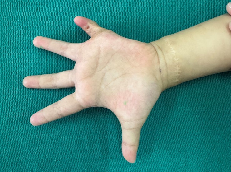 Áp dụng kỹ thuật tạo hình điều trị sẹo co kéo phức tạp bàn - ngón tay trẻ em- Ảnh 1.