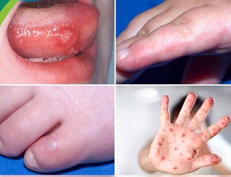 CÁCH PHÒNG, CHỐNG BỆNH TAY CHÂN MIỆNG- Ảnh 3.