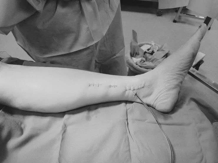 BVĐK Hòe Nhai phẫu thuật cấp cứu thành công người bệnh gãy kín xương cẳng chân do tai nạn sinh hoạt- Ảnh 1.