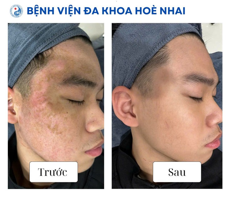 Điều trị mụn ở tuổi dậy thì đừng để quá muộn- Ảnh 1.