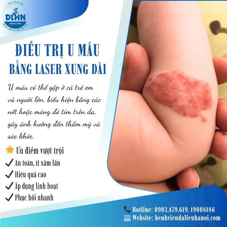Bệnh viện Da liễu Hà Nội triển khai điều trị u máu bằng Laser xung dài- Ảnh 1.