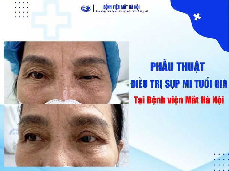 Bệnh viện Mắt Hà Nội phẫu thuật thành công nhiều ca sụp mi tuổi già- Ảnh 1.